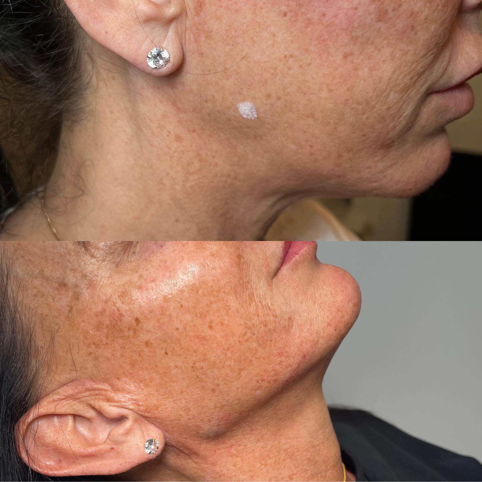Facial Filler Results 4