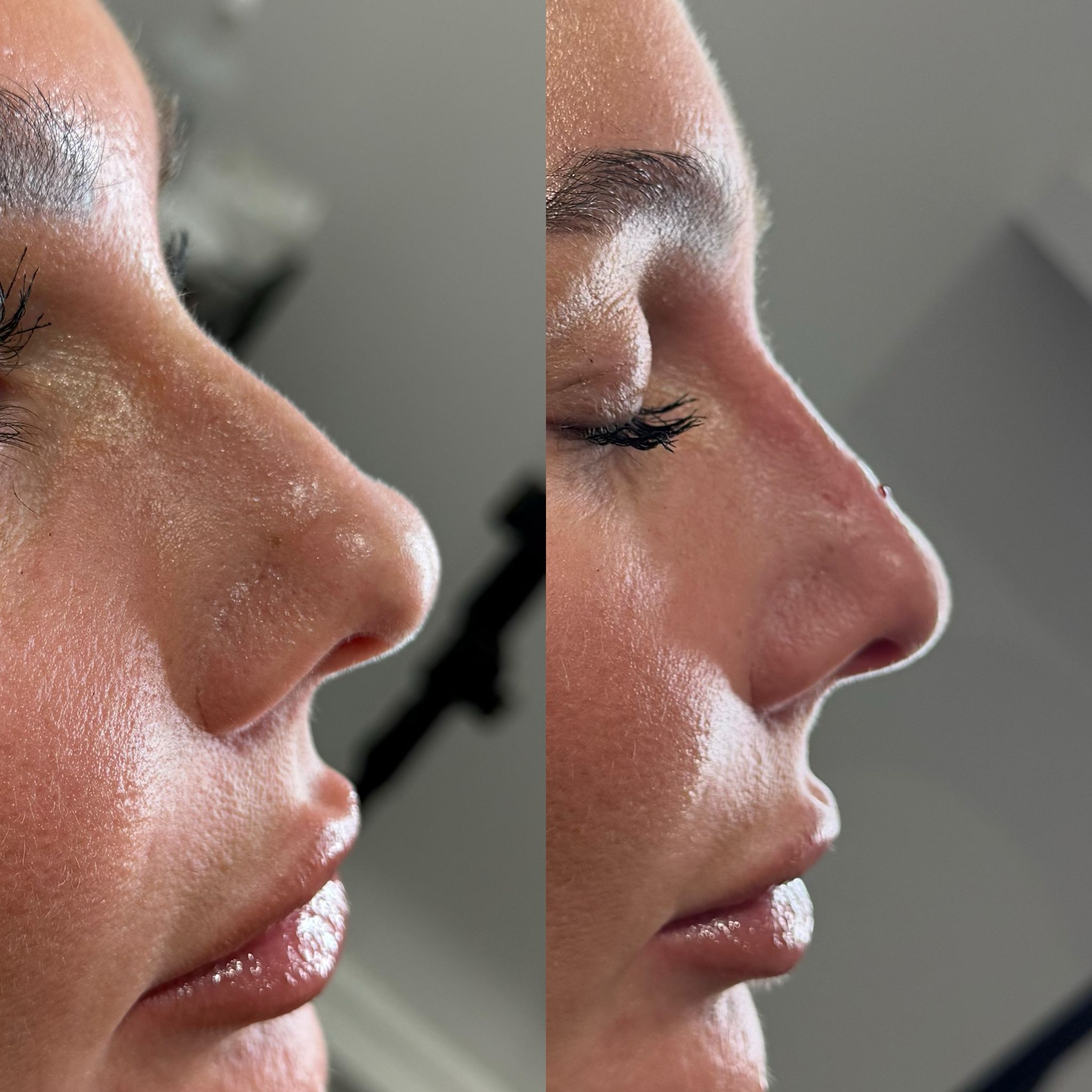 Facial Fillers - the chislehurst clinic