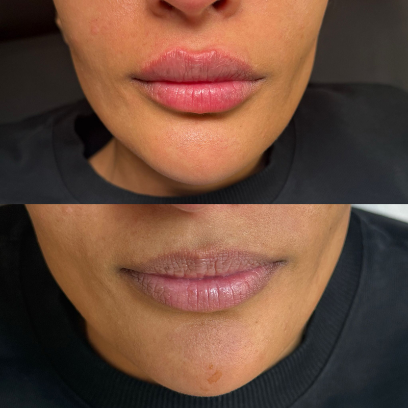 Lip Fillers