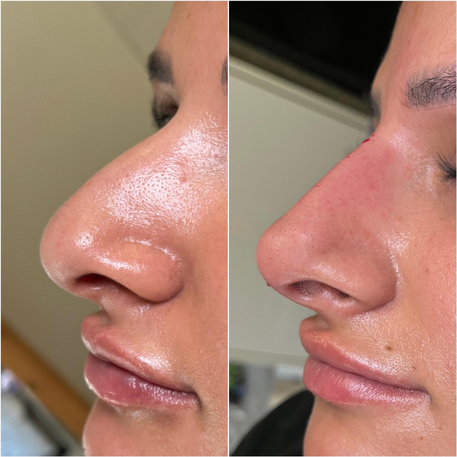 Nonsurgical Rhinoplasty Rhinomodelling or nasal bioplasty 